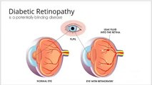 Diabetic Eye Disease | Diabetic Retinopathy