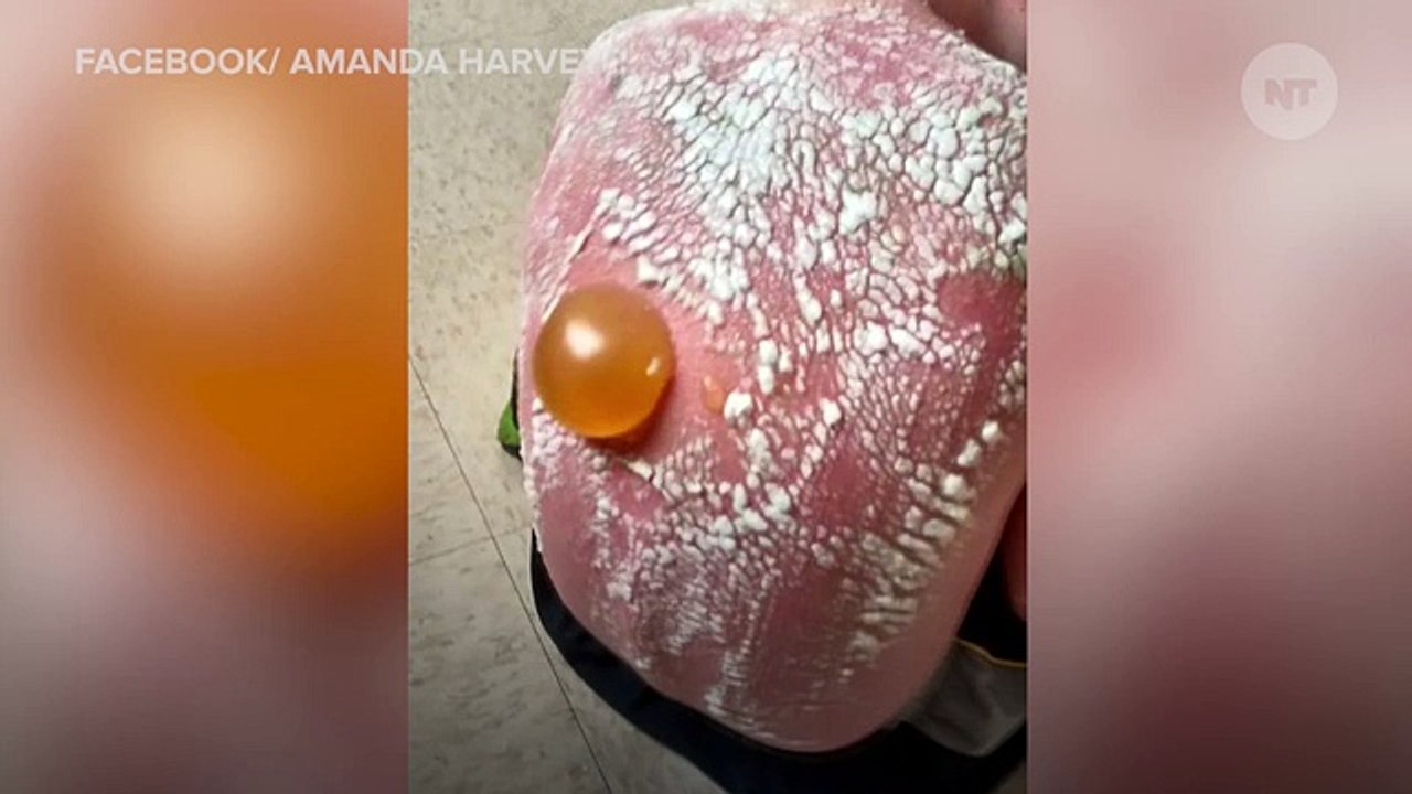 Children Get Horrifically Sunburned After Daycare Neglects Them