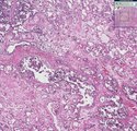 Histopathology Testis--Embryonal carcinoma