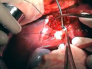 Liver resection (Left Lateral Segmentectomy) by Dr Hitesh Chavda