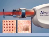 Pixel Laser Skin rejuvenation