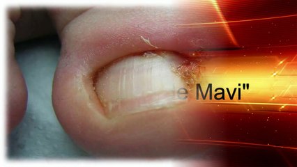 Uñas encarnadas de los dedos del pie o uñero - Que hacer - Como curar