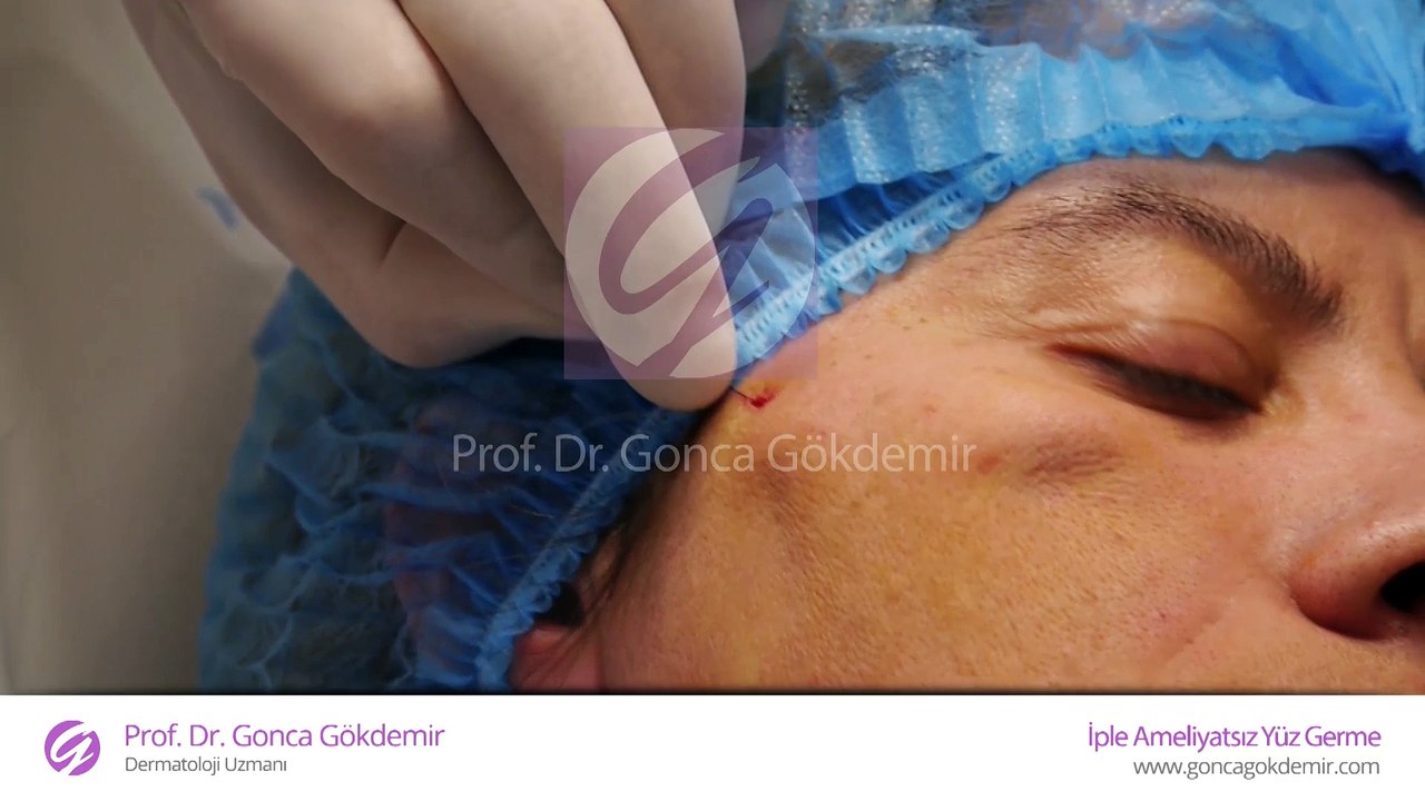 İple yüz germe - Prof. Dr. Gonca Gökdemir