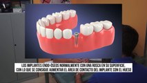 Oferta  Implantes dentales INFOESTETICA Alicante Clases de implantes dentales