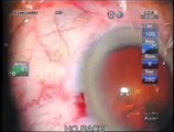 HORACE   HORIZONTAL ROTATION ASSISTED CATARACT EXTRACTION