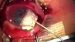 AHMED Valve implant in congenital aniridia