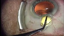 Secondary Intraocular Lens Implantion after Cataract Surgery