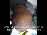 Hair Transplant Abroad - FUE hair transplant procedure