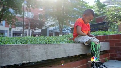 1st Successful Double Hand Transplant of a Baby