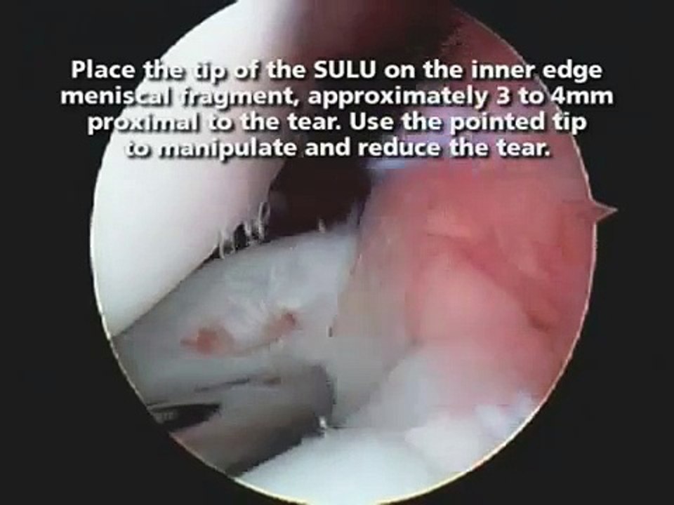 Repair of a Posterior Horn Tear of the Lateral Meniscus