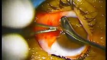 Chirurgie de Ptérygion avec autogreffe conjonctivale par Dr.Yasser RIFAY
