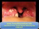 Waterpik tonsil stones  ♣♣♣ How to remove Tonsil Stones ♣♣