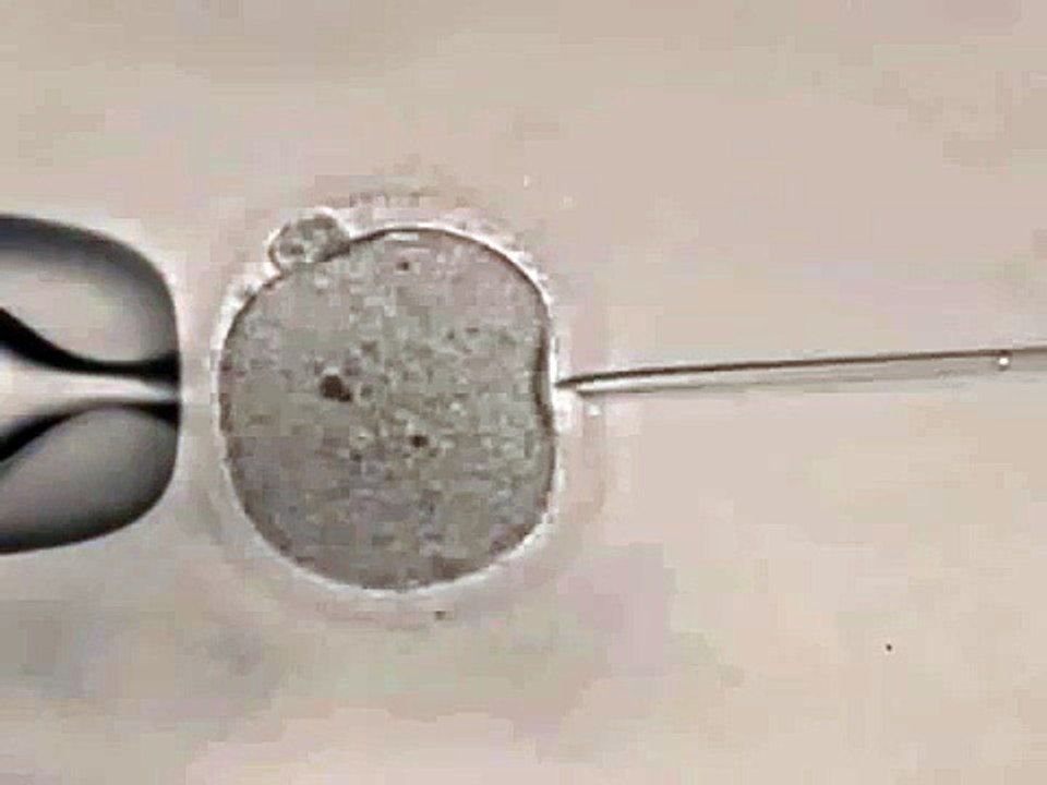 Injeção intracitoplasmática de espermatozóide (ICSI)