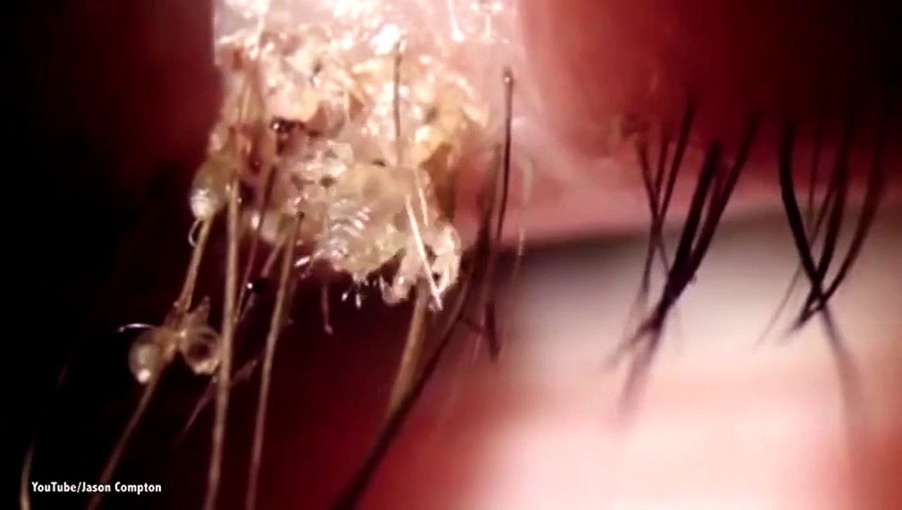 You'Ll Need To Rub Your Eyes! An Up Close View Eye Lice