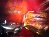 Beating Heart Totally Endoscopic Coronary Artery Bypass