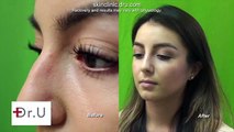 Incredible Nose Job Results Without Surgery - Before and After Radiesse