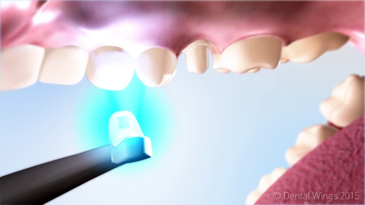 Dental Wings Laser Milling (DWLM) - video Dailymotion