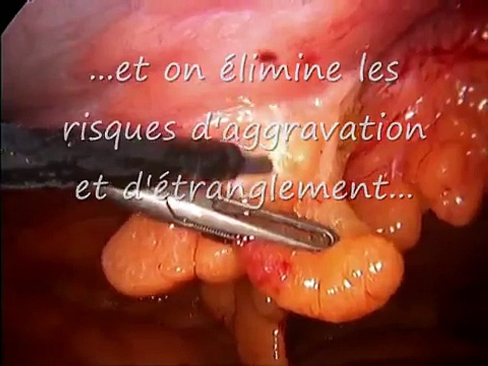 Hernie ombilicale coelio (Laparoscopic umbilical hernia repair)
