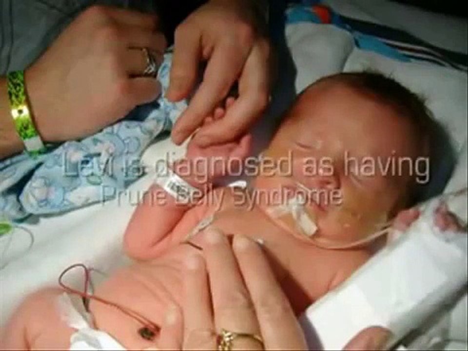 SINDROME DE PRUNE BELLY