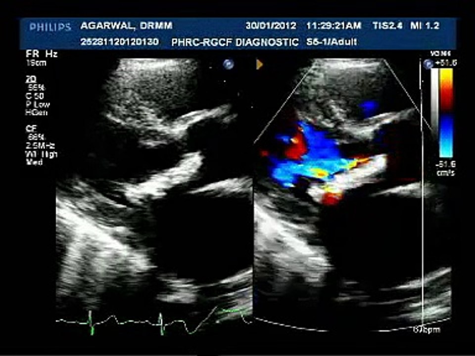 Heart MVR - 2D+3D Echocardiography - Mr. Satish Aggarwal