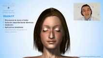 Cómo se hace una Rinoplastia (3D) | Cirugía de Nariz