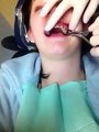 Getting my Palate Expander taken out!