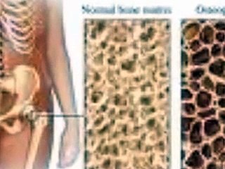 Dangers of drinking cow's milk