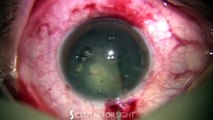 Victus Femtosecond Laser Cataract Surgery and Translens Hydrodissection