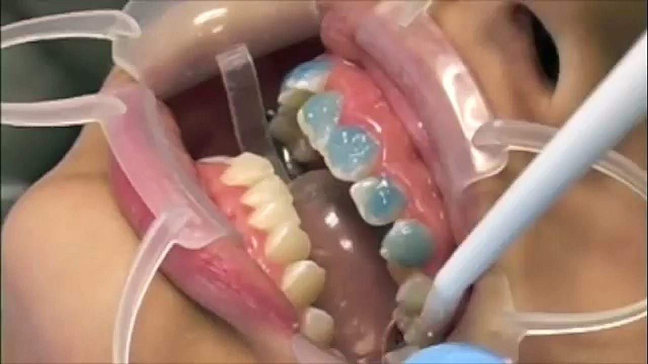 Indirect Bonding Using Custom IQ & Assure