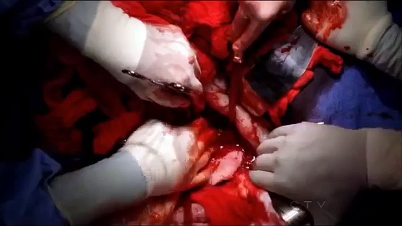 Grey's Anatomy 9x05 Meredith's Dancing Surgery``