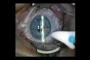 PRK Photorefractive Keratectomy Excimer Laser Refractive Eye Surgery