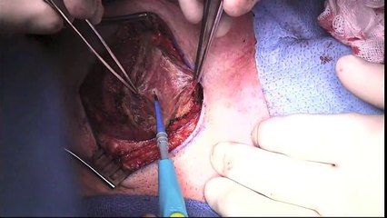 Thyroidectomy - risk and its complications