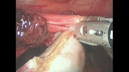 SELS: Total Laparoscopic Hysterectomy & Bilateral Salpingo-Oophorectomy