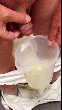 Bağırsaktan Yapay Mesane Ameliyatı 2 Ay Sonrası Hasta Gözlemi - Prof. Dr. Tahir Karadeniz