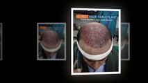 Hair transplant video Pakistan, Affordable FUE hair transplant Pakistan