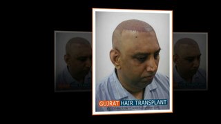 Video of FUE hair transplant in Pakistan by UK trained team
