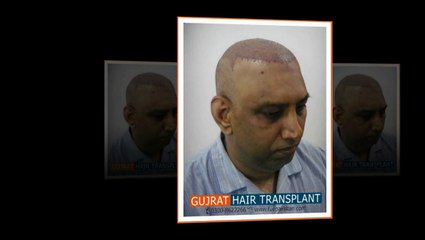 Video of FUE hair transplant in Pakistan by UK trained team