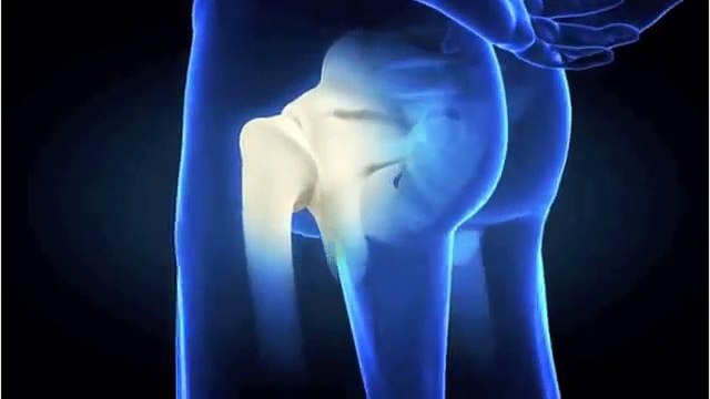 Johnson & Johnson Hip Implant Recall Explained by Orthopedic Surgeon