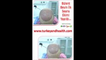SAÇ EKİM ÖNCESİ SONRASI, İSTANBUL SAÇ EKİM MERKEZİ, İstanbul hair, haircenter, Hair Transplant Center