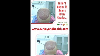 SAÇ EKİM ÖNCESİ SONRASI, İSTANBUL SAÇ EKİM MERKEZİ, İstanbul hair, haircenter, Hair Transplant Center