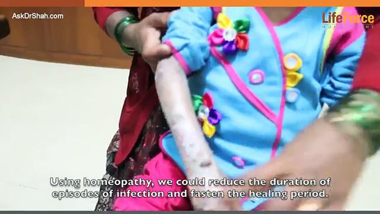 A Kid with Severe Epidermolysis Bullosa (EB) on Hands, Knees & Legs Treated