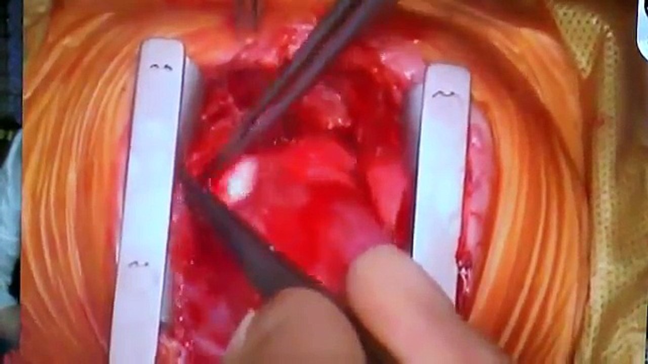 Pediatric Heart Transplant at Seattle Children's
