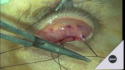 Ptosis surgery. Conjunctivo mullerectomy