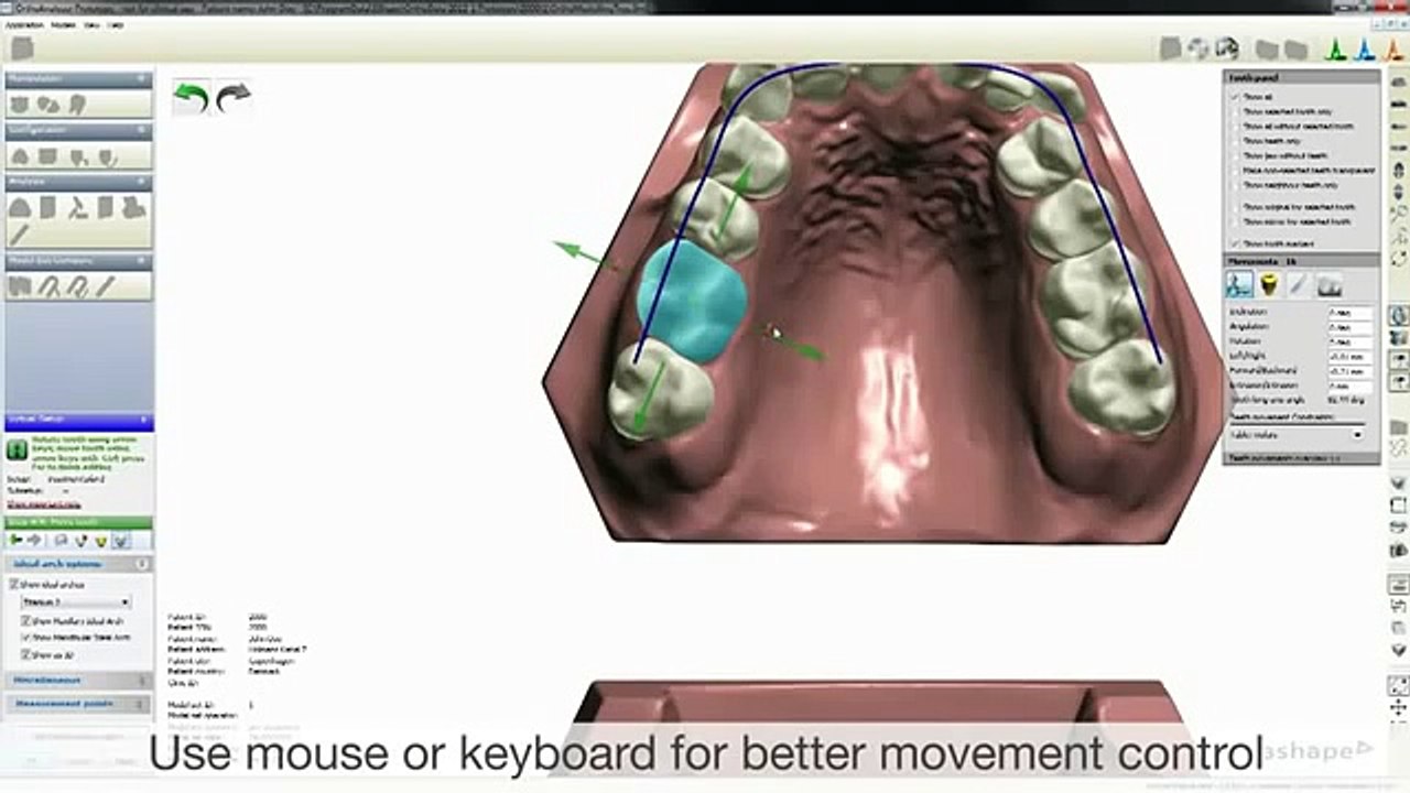 Ortho Analyzer - Treatment Planner -3Shape