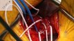 The Mount Sinai Surgical Film Atlas: Endovascular Repair of an Abdominal Aortic Aneurysm