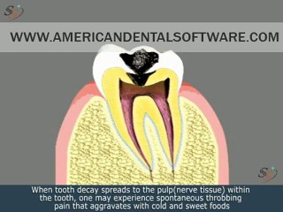 Dental Patient Education Root Canal Treatment Animated Movie