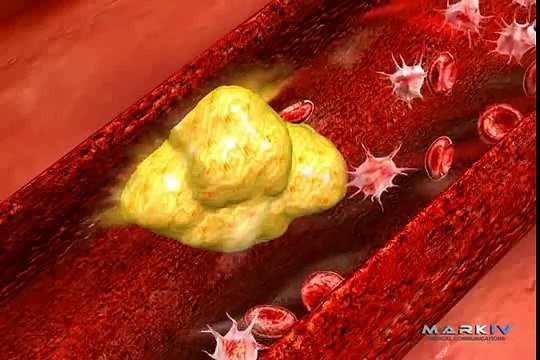 Acute Myocardial Infarction - Heart Attack