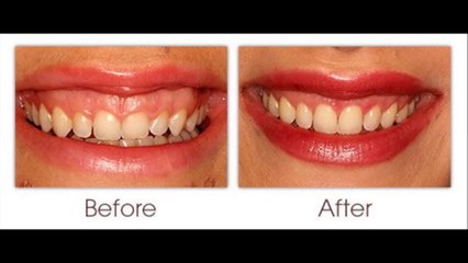 Gum Recession Beverly Hills
