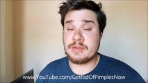 Acne No More Review - How I got rid of pimples from my face and back in 30 days with Acne no More