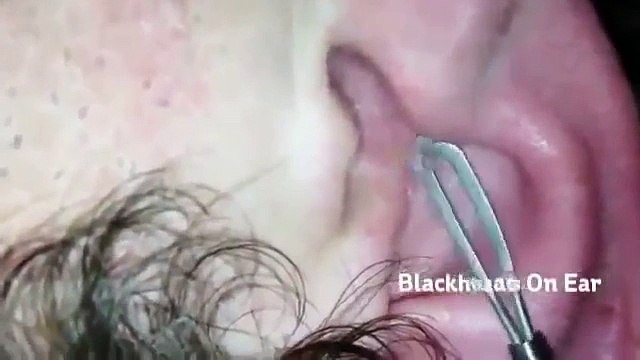 How to I Remover Blackheads from my Ears Blackhead On Nose Removal